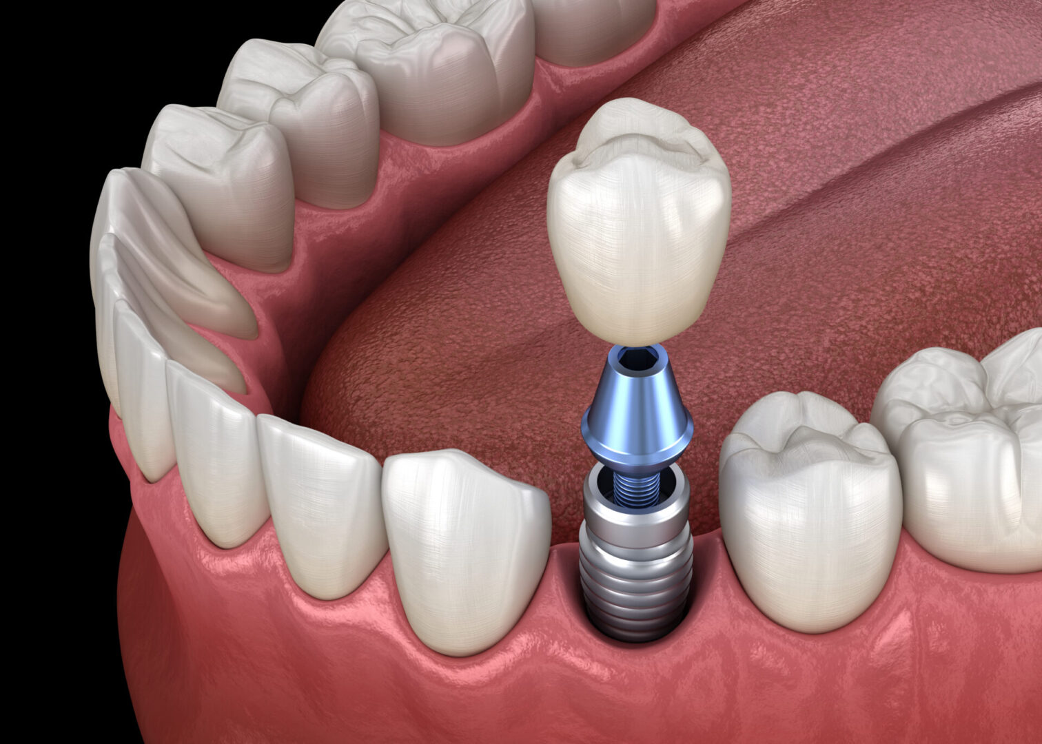 Premolar,Tooth,Crown,Installation,Over,Implant,Abutment.,Medically,Accurate,3d