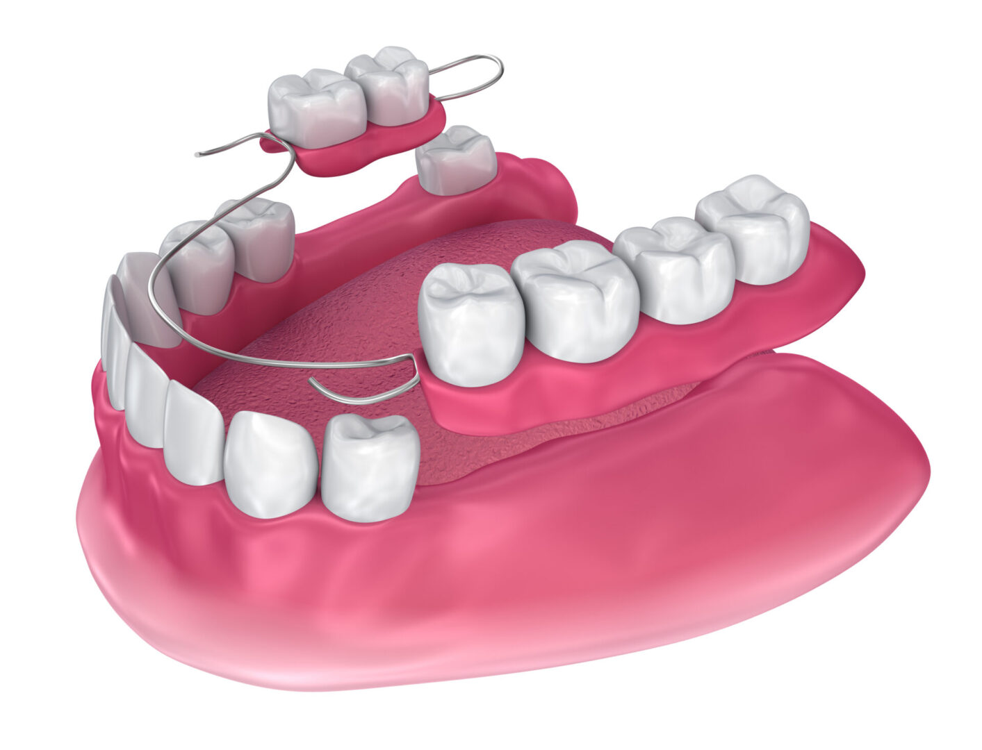 Removable,Partial,Denture.,Medically,Accurate,3d,Illustration