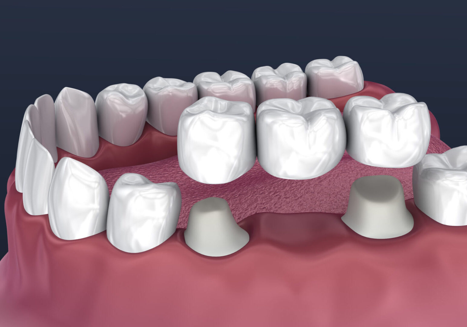 Tooth,Supported,Fixed,Bridge,Of,3,Teeth.,Medically,Accurate,3d