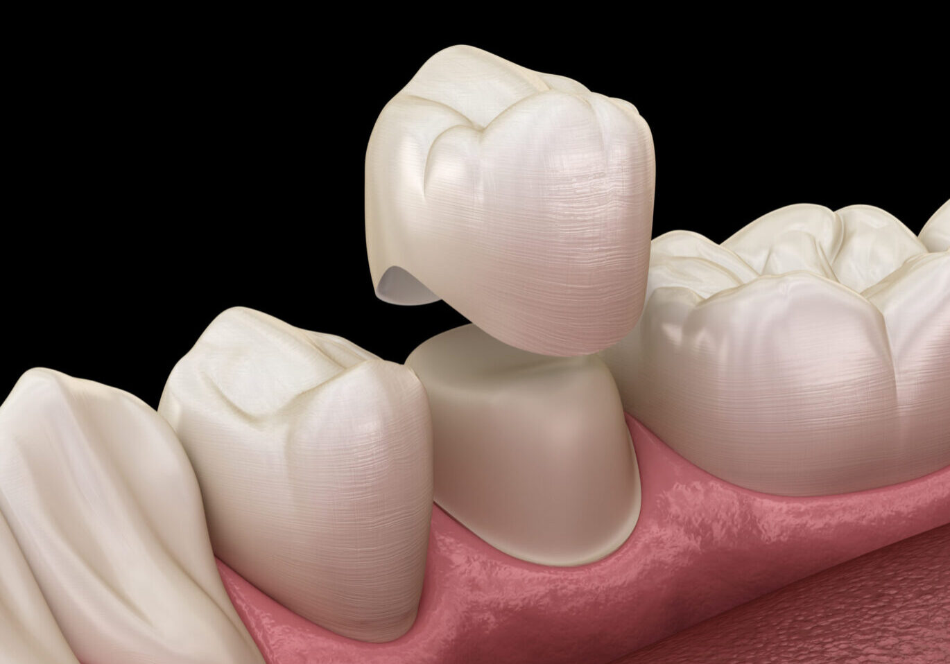 Dental,Crown,Premolar,Tooth,Assembly,Process.,Medically,Accurate,3d,Illustration